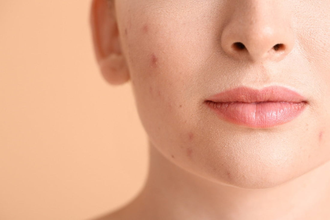 5 Best Ways To Remove Blemishes From Your Skin