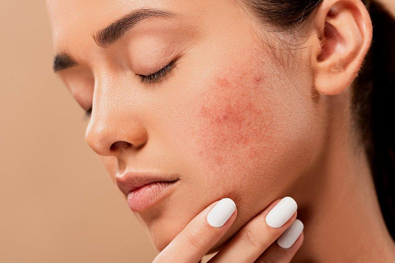 Close-up of woman with acne and redness on cheek, touching her face, skincare concern