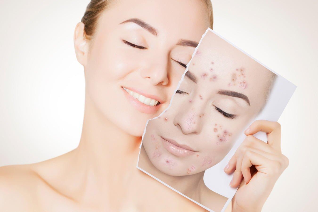 3 Natural treatments To Remove Pimples - Oshea Herbals