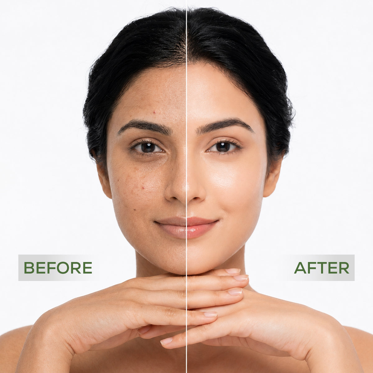 Neem Pure Anti Acne & Pimple Cream