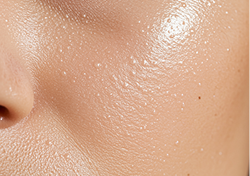 Oily Skin