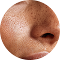 Enlarged Pores